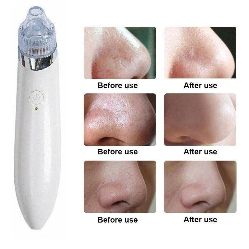 Blackhead Remover Vacuum Acne Cleaner – Deep Pore Cleansing for Flawless Skin